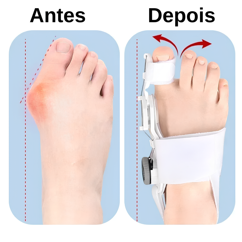 Corretor de Joanetes Ajustável - OrthoFlex